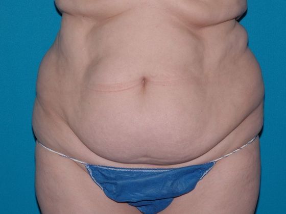 Carmel Cosmetic & Plastic Surgeons' Patient Before Abdominoplasty