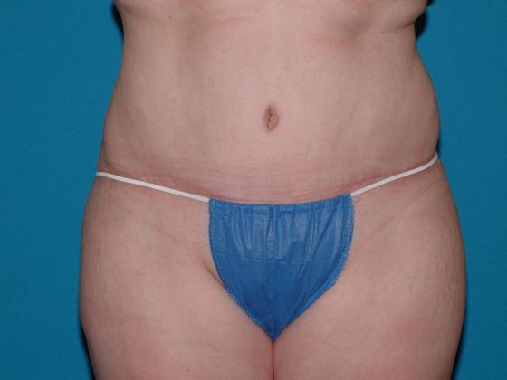 Carmel Cosmetic & Plastic Surgeons' Patient After Abdominoplasty