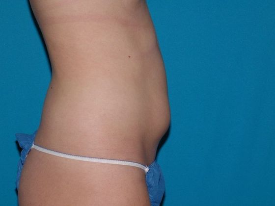 Carmel Cosmetic & Plastic Surgeons' Patient before liposuction procedure